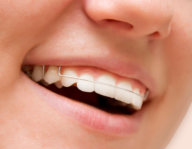 Orthodontic Retainers