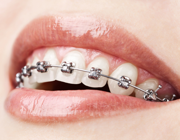Close up of the smile of a woman with Damon braces