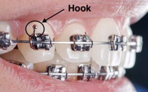 Close Up Of Hook On Braces