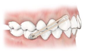 Model Of Rubber Band On Teeth Wearing Braces