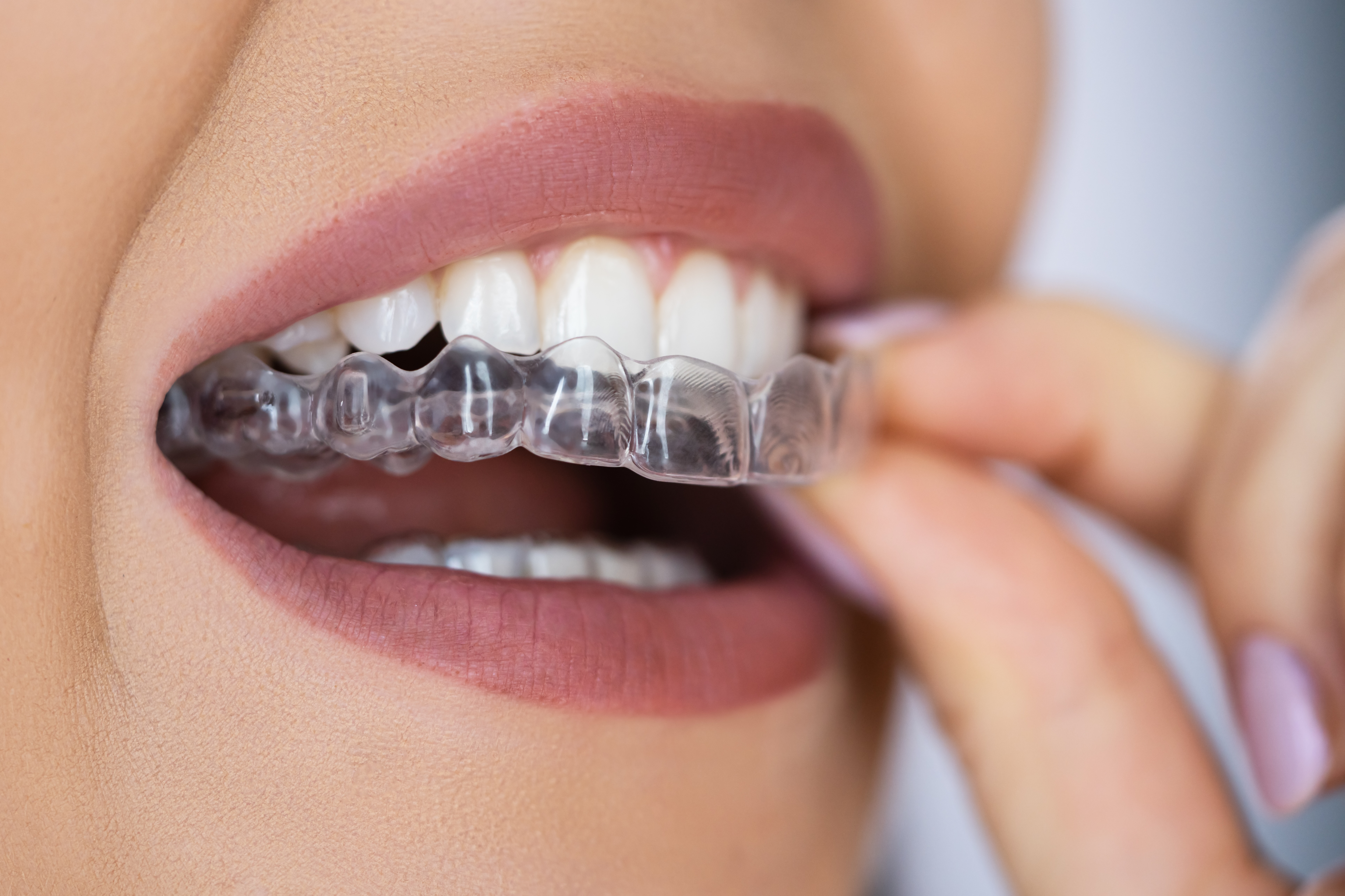 Clear Aligner Dental Guard