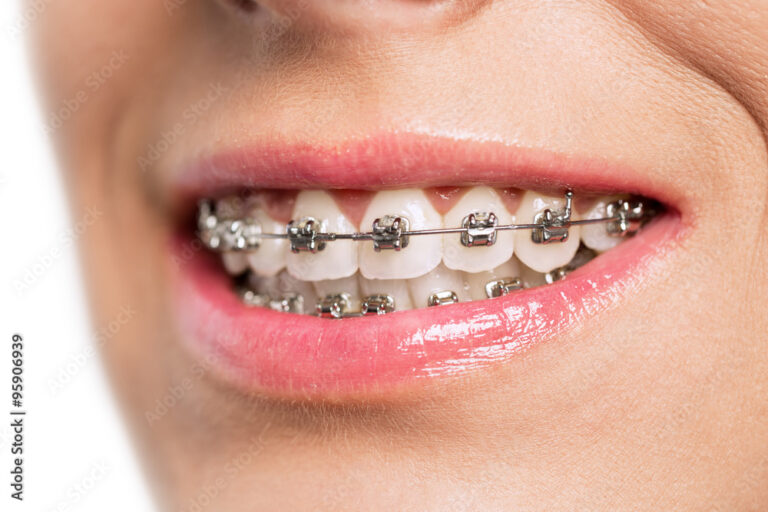 Close up of the smile of a young woman with braces