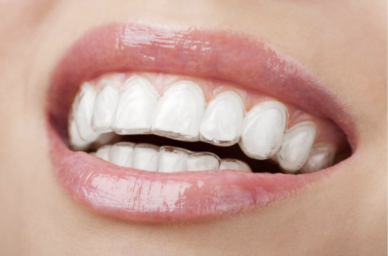 Close up of the smile of a woman wearing clear aligners