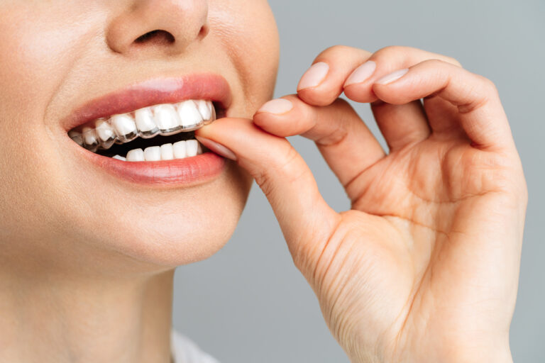 Close up of a woman with Invisalign for adults pushing her aligner into place with her thumb