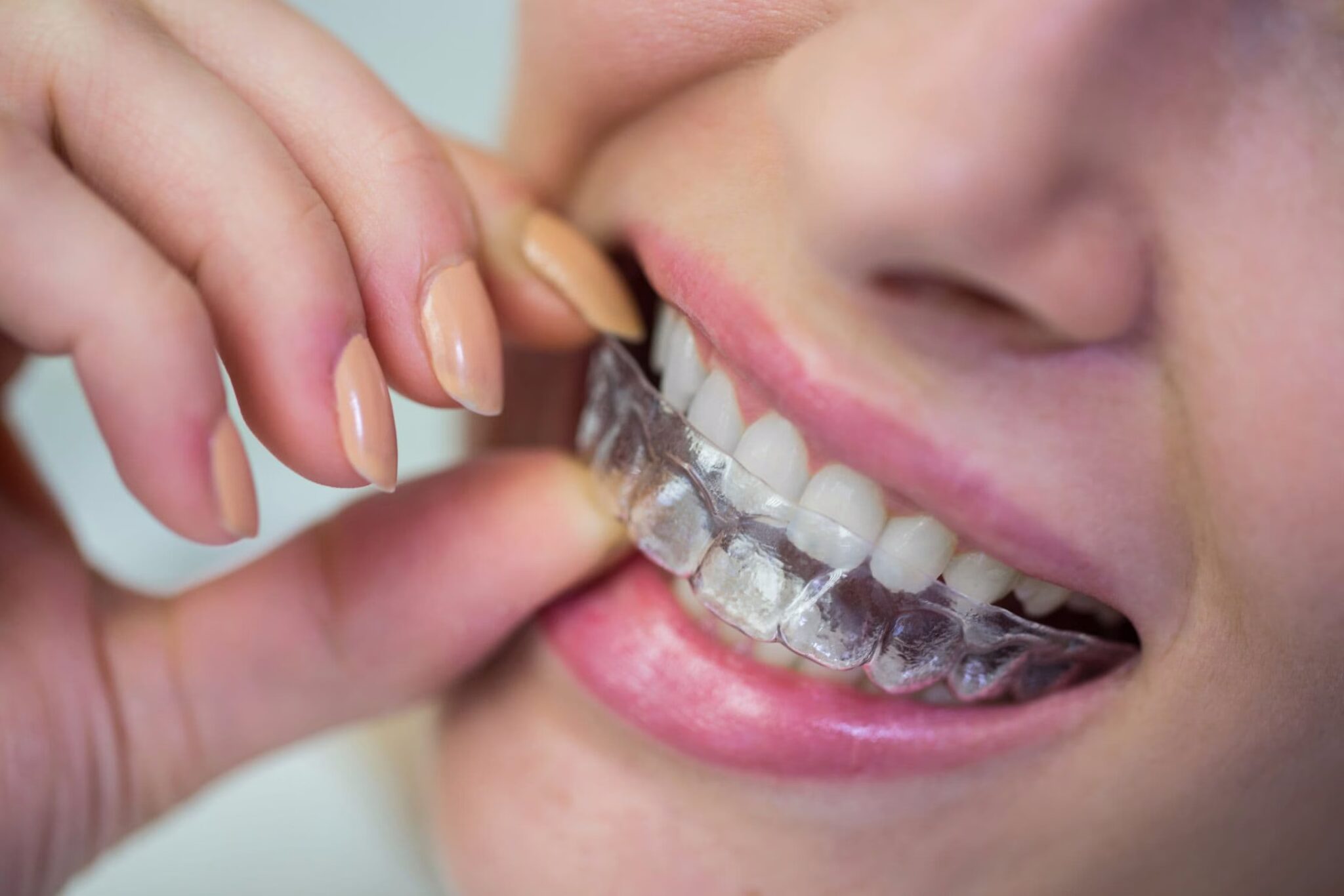 Invisalign Hands
